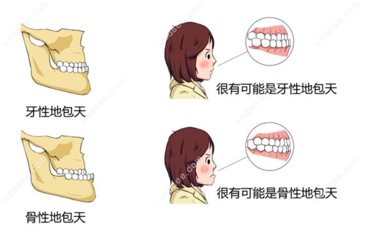 牙性和骨性地包天