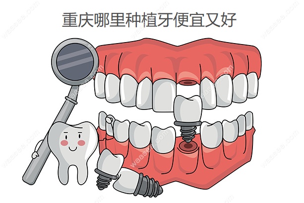 重庆哪里种植牙便宜又好