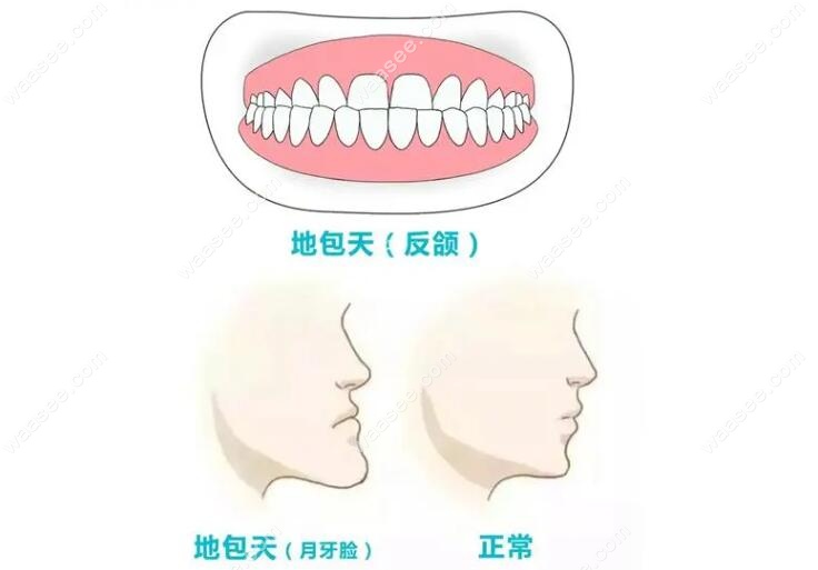 正常牙齿和地包天牙齿