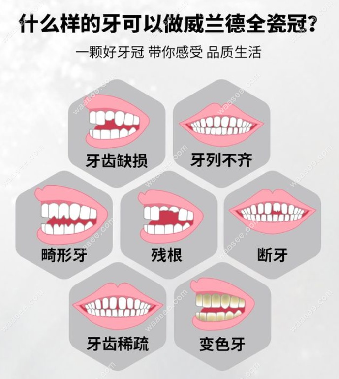 德国威兰德全瓷牙价格www.waasee.com