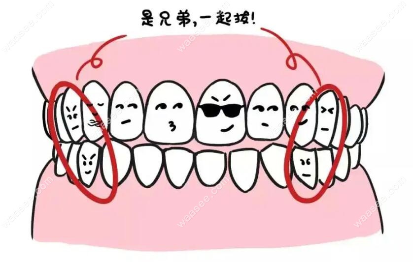 正畸过程中拔4正畸牙