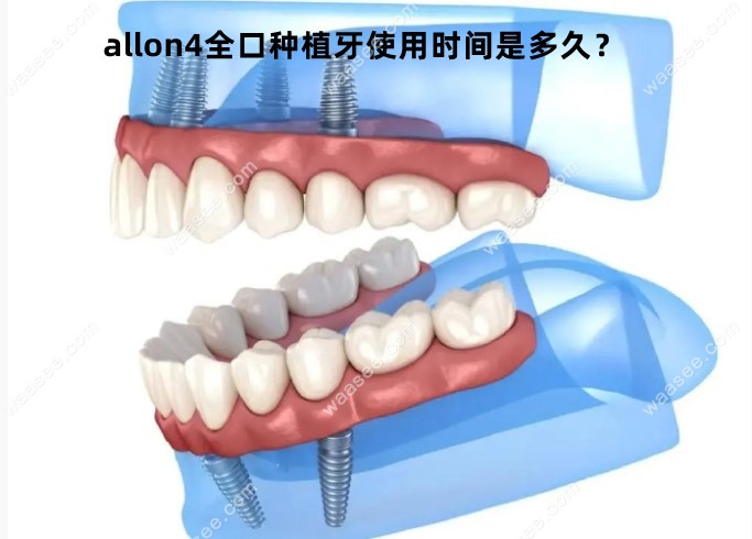 allon4全口种植牙使用时间waasee.com