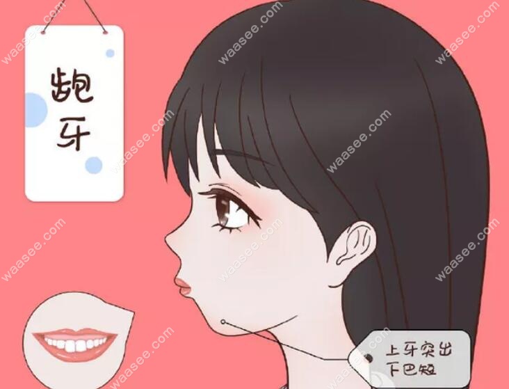 龅牙矫正可以拔4号牙吗