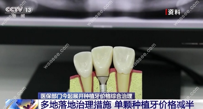种植牙集采是报销的意思吗