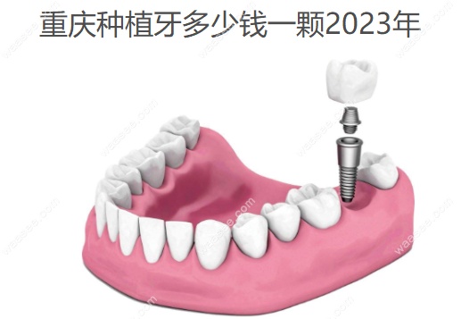 重庆种植牙多少钱一颗2023年
