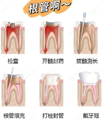 根管治疗步骤
