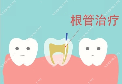 根管治疗图