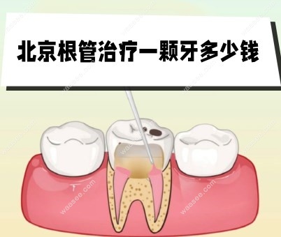 北京根管治疗一颗牙多少钱