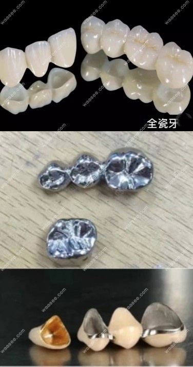牙冠的种类