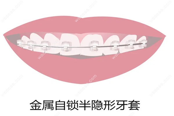 成人金属自锁矫正价格www.waasee.com