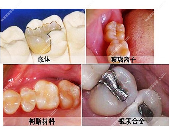 不同的补牙材料的<span style=