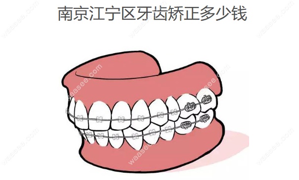 南京江宁区牙齿矫正多少钱