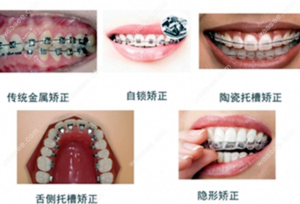 牙齿矫正器的类型