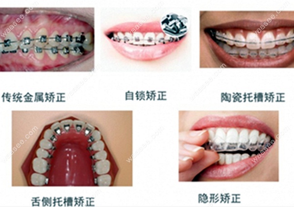 牙齿矫正器的类型www.waasee.com
