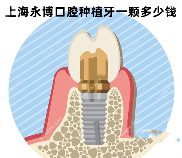 <!--<i data=20240703-sp></i>-->永博口腔种植牙