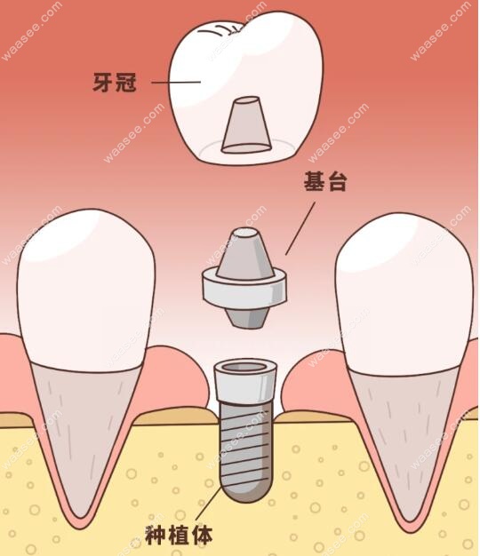 深圳公明种植牙价格www.waasee.com