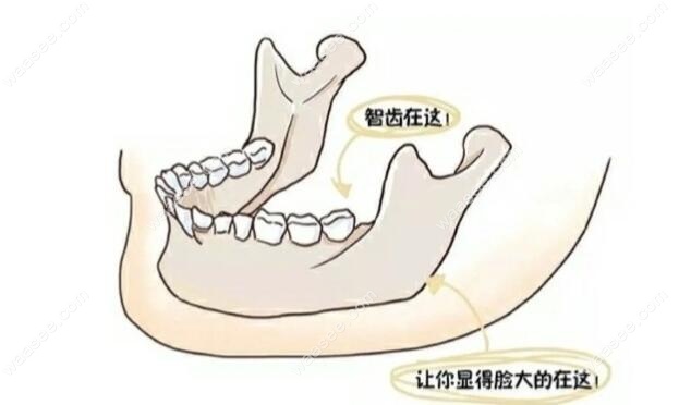 拔智齿影响脸型吗？