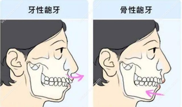 骨性地包天戴牙套能矫正吗 骨性地包天戴牙套能矫正吗