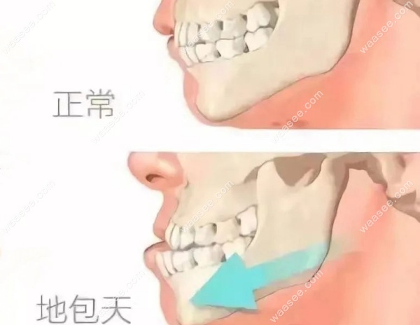 骨性地包天矫正需要多少钱 骨性地包天矫正需要多少钱