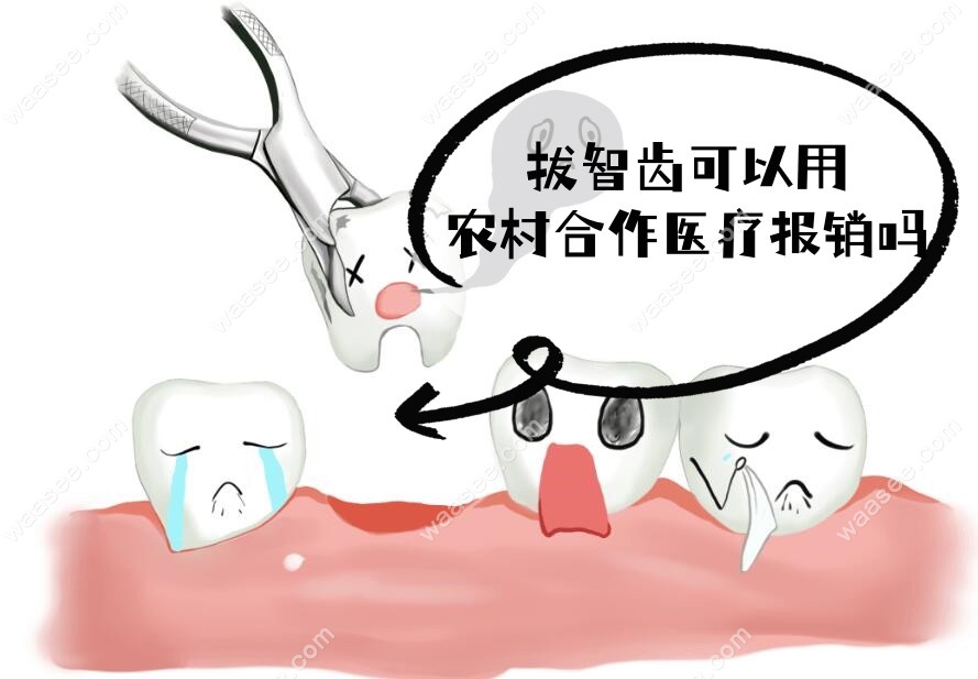 拔智齿可以用农村合作医疗报销吗www.waasee.com