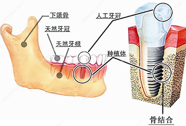 种植牙与真牙的区别