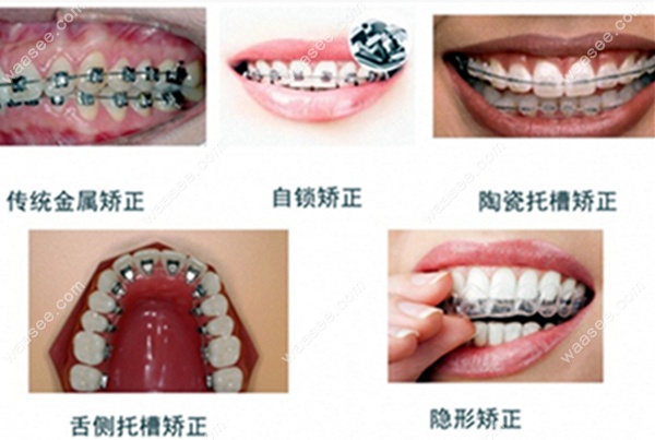 牙齿矫正器的类型www.waasee.com