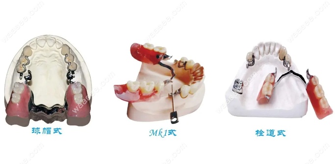 三种无挂钩假牙图片