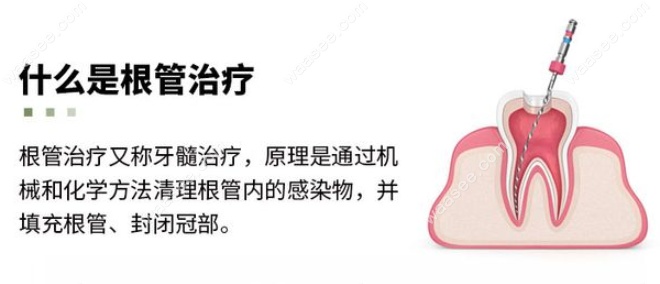 根管治疗加上补牙一共多少钱
