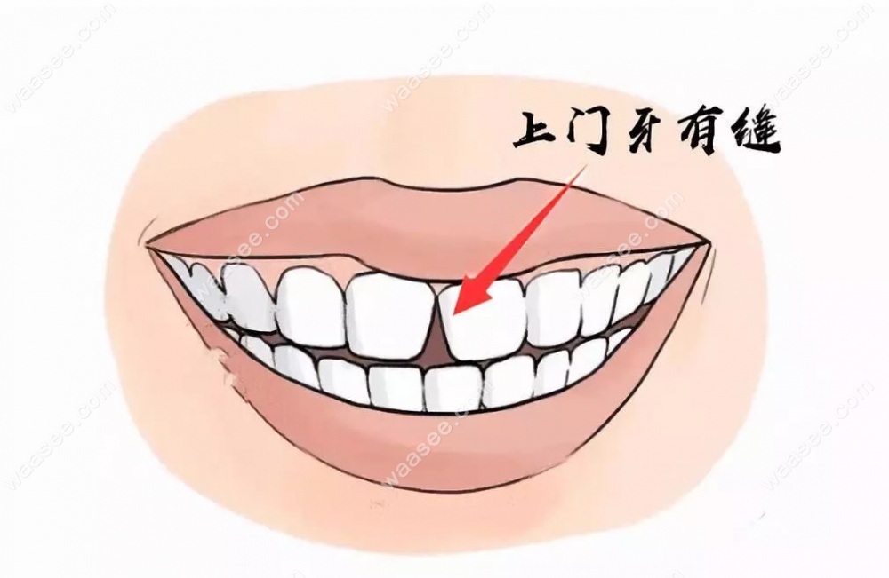 美国隐适美first一期二期价格waasee.com