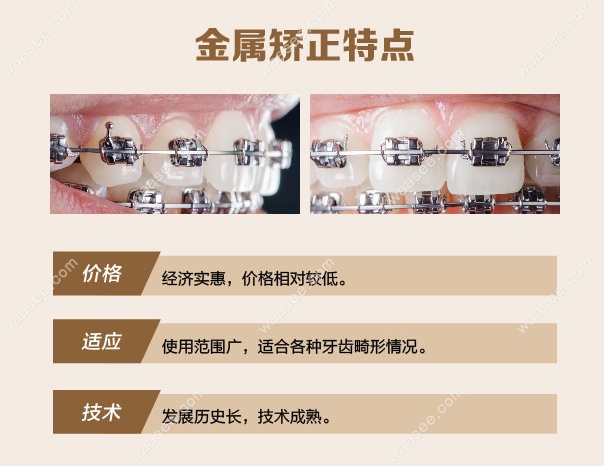 金属自锁托槽矫正多少钱