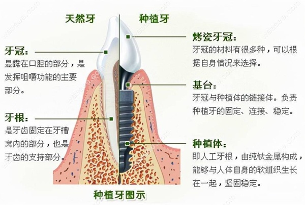 种植牙与天然牙的对比www.waasee.com