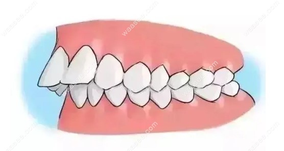 青少年牙齿矫正哪种更好一些www.waasee.com