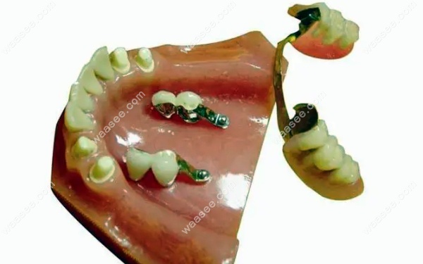 精密附着体义齿单颗可以做吗waasee.com