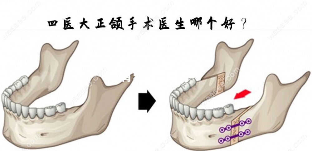 四医能做正颌手术的医生哪个好waasee.com