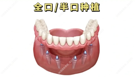全口种植牙