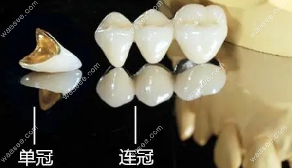 上海口腔烤全瓷牙价格