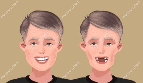 50-60岁全口种植牙