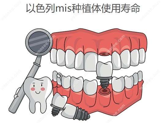 以色列mis种植体使用寿命