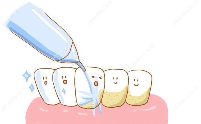 衡水可恩口腔医院洗牙价格