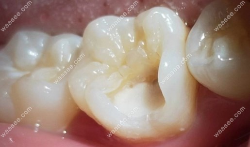 衡水可恩口腔补牙收费