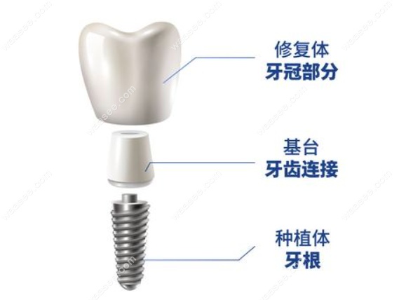 德国朗斯种植牙多少钱一颗