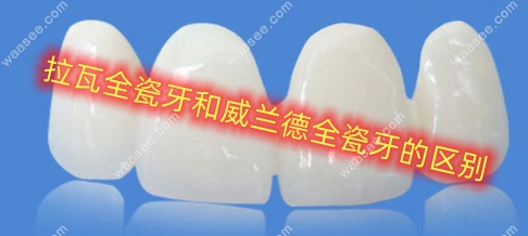 拉瓦全瓷牙和威兰德全瓷牙的区别