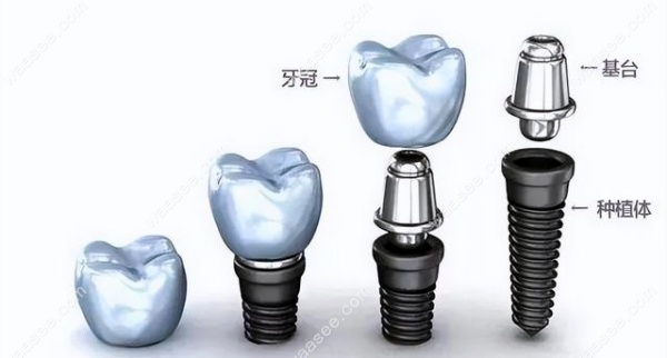 <!--<i data=20240703-sp></i>-->雅洁口腔医院种植牙价格表