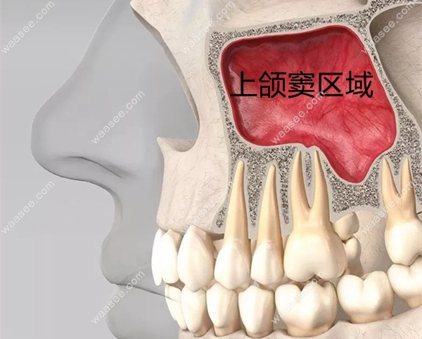 口腔内的上颌窦区域展示