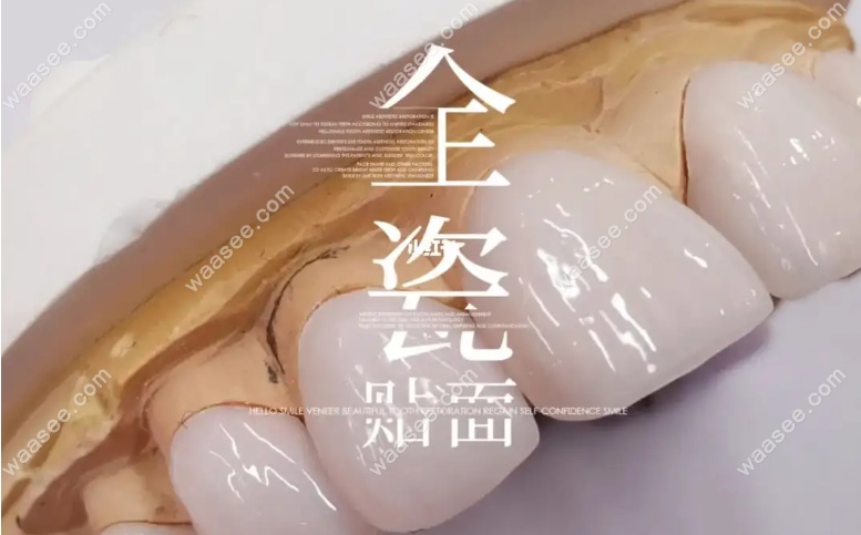 瓷贴面和树脂贴面的优缺点www.waasee.com