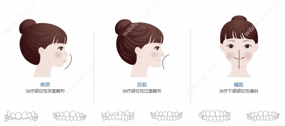 正雅隐形牙齿矫正GS版缺点
