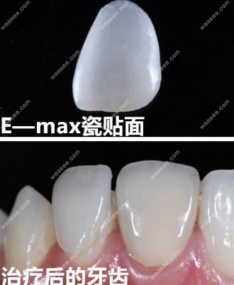 emax贴面前后对比