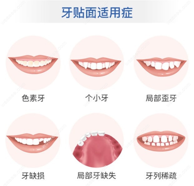 牙贴面适应症
