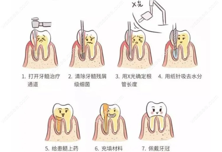 贵阳市口腔医院根管治疗费用