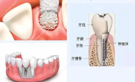 牙槽骨植骨手术方式有：自体植骨或者是骨替代品移植
